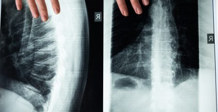 How Much Can You Get From a Spinal Cord Injury Claim